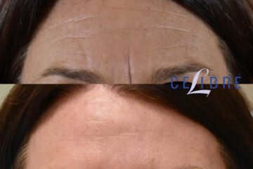 Botox