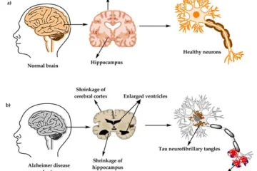 Alzheimer's